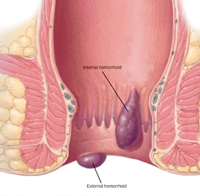 Hemorrhoids Internal External